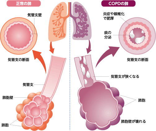 Copd 慢性閉塞性肺疾患 健康サポート室ニュース